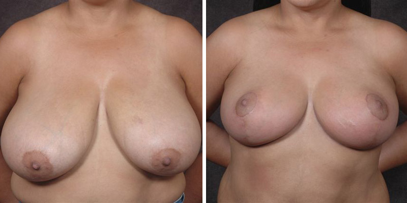 Dr. Kao Breast Reduction