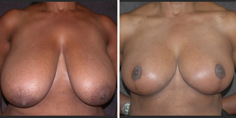 Dr. Kao Breast Reduction