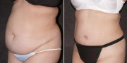 Dr. Kao Tummy Tuck (Abdominoplasty)