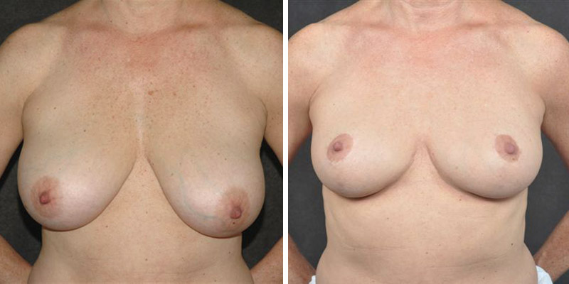 Dr. Kao Breast Reduction