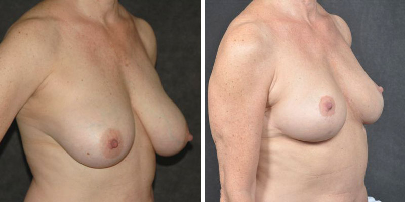 Dr. Kao Breast Reduction