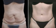 Dr. Kao Tummy Tuck (Abdominoplasty)