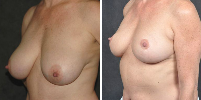 Dr. Kao Breast Reduction