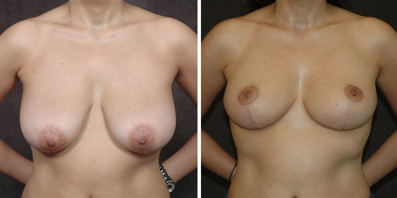 Dr. Kao Breast Lift