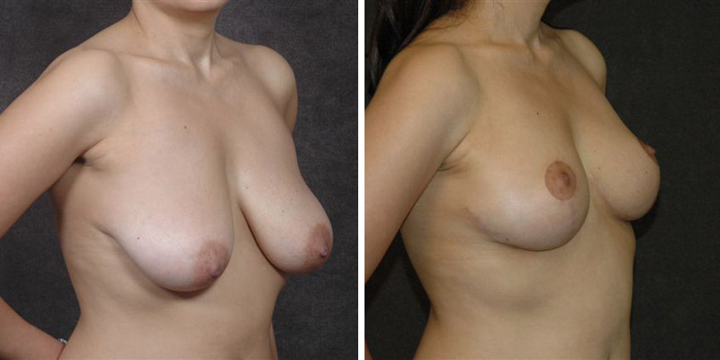 Dr. Kao Breast Lift