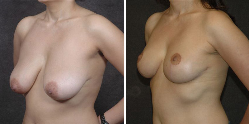 Dr. Kao Breast Lift