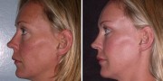 Dr. Kao Ponytail Facelift