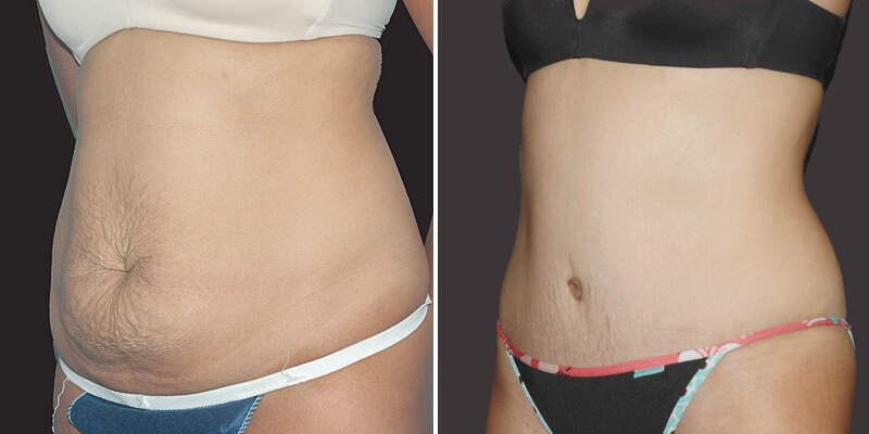 Dr. Kao Tummy Tuck (Abdominoplasty)