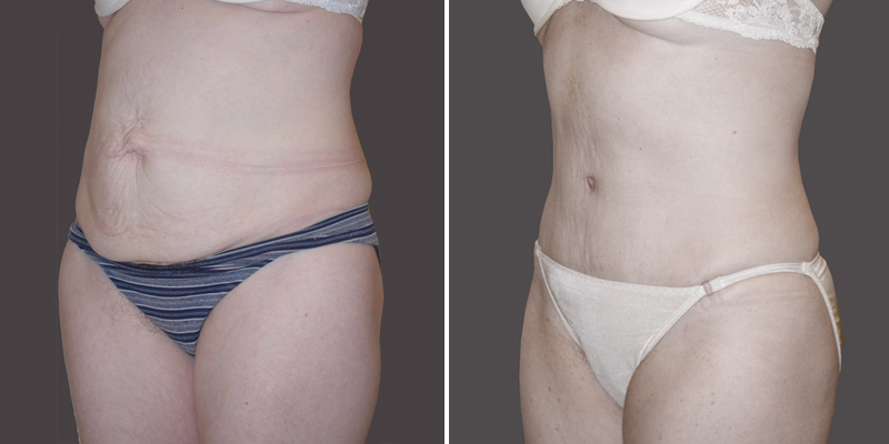 Dr. Kao Tummy Tuck (Abdominoplasty)