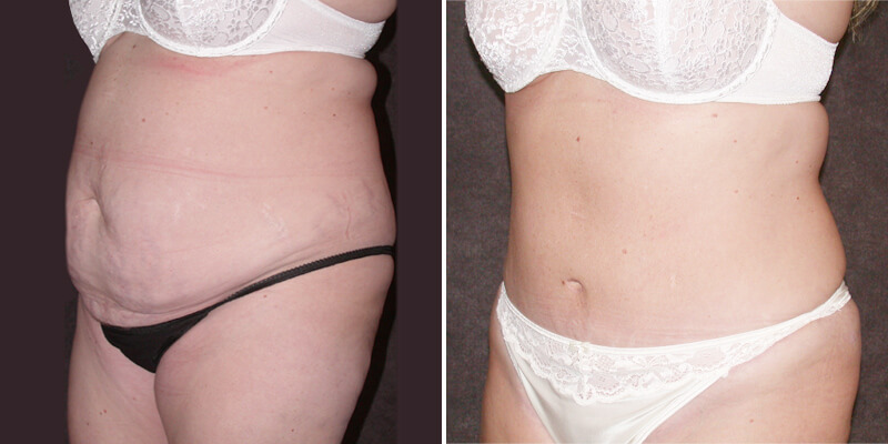 Dr. Kao Tummy Tuck (Abdominoplasty)