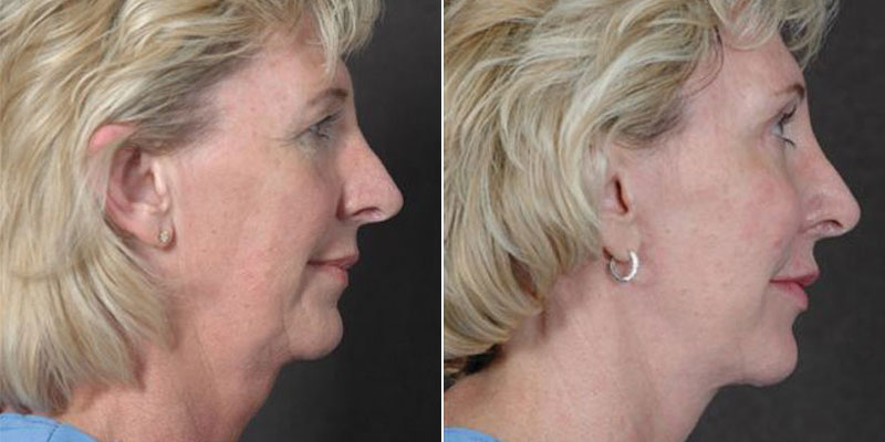 Dr. Kao Ponytail Facelift