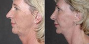 Dr. Kao Ponytail Facelift