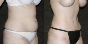 Dr. Kao Tummy Tuck (Abdominoplasty)