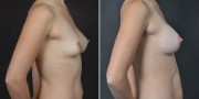 Dr. Kao Breast Augmentation