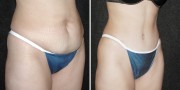 Dr. Kao Tummy Tuck (Abdominoplasty)