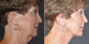 Dr. Kao Ponytail Facelift