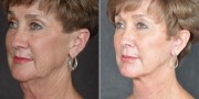 Dr. Kao Ponytail Facelift