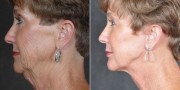 Dr. Kao Ponytail Facelift