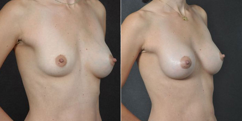 Dr. Kao Breast Augmentation