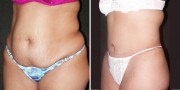 Dr. Kao Tummy Tuck (Abdominoplasty)