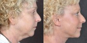 Dr. Kao Ponytail Facelift