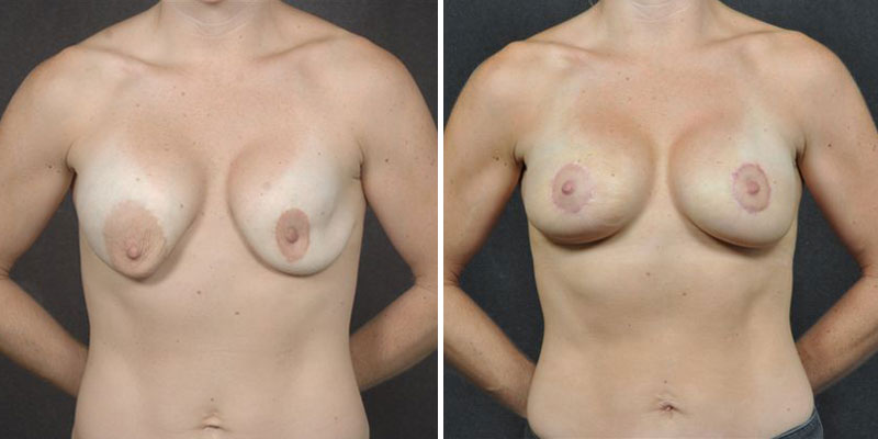 Dr. Kao Breast Implant Revision