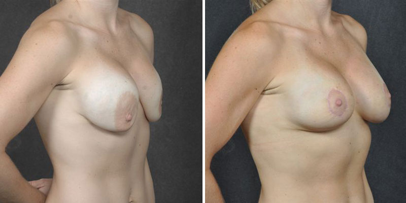 Dr. Kao Breast Implant Revision