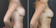 Dr. Kao Breast Implant Revision