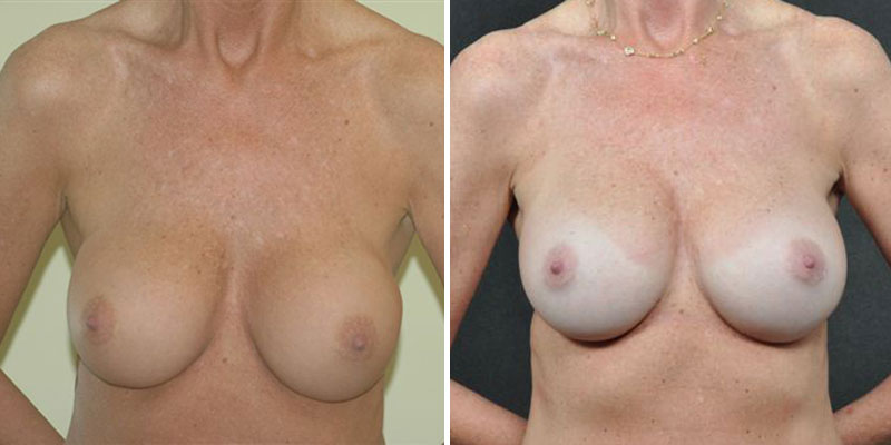 Dr. Kao Breast Implant Revision
