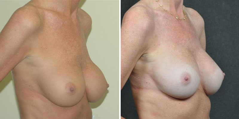 Dr. Kao Breast Implant Revision