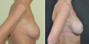 Dr. Kao Breast Implant Revision