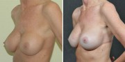 Dr. Kao Breast Implant Revision