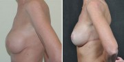 Dr. Kao Breast Implant Revision