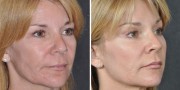 Dr. Kao Ponytail Facelift