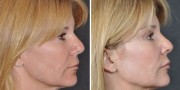 Dr. Kao Ponytail Facelift