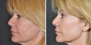 Dr. Kao Ponytail Facelift