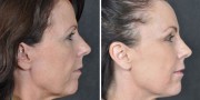 Dr. Kao Ponytail Facelift