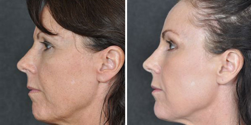 Dr. Kao Ponytail Facelift