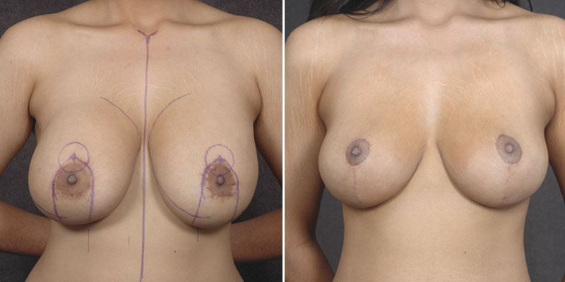 Dr. Kao Breast Lift with Implants