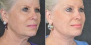 Dr. Kao Ponytail Facelift