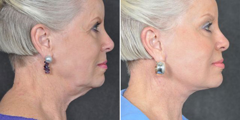 Dr. Kao Ponytail Facelift