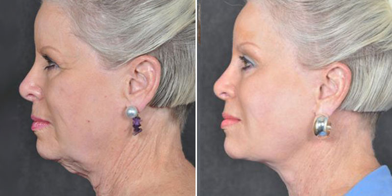 Dr. Kao Ponytail Facelift