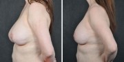 Dr. Kao Breast Implant Revision