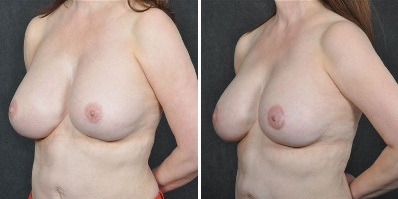 Dr. Kao Breast Implant Revision