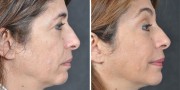 Dr. Kao Ponytail Facelift