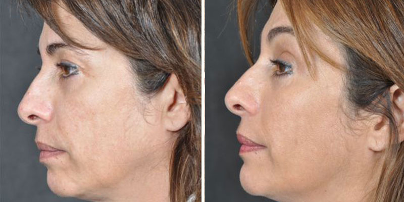 Dr. Kao Ponytail Facelift