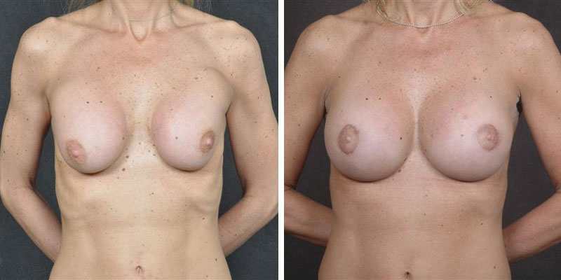 Dr. Kao Breast Implant Revision