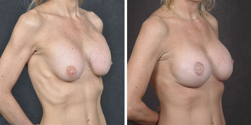 Dr. Kao Breast Implant Revision