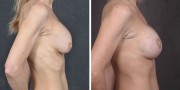 Dr. Kao Breast Implant Revision