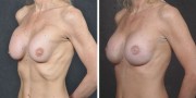 Dr. Kao Breast Implant Revision